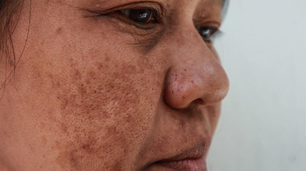 Melasma